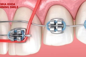 Tháo vít niềng răng: Đau đớn hay không đáng lo ngại?