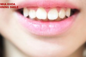 Niềng răng có làm răng yếu đi? Bí mật từ Shining Smile đã sáng tỏ!