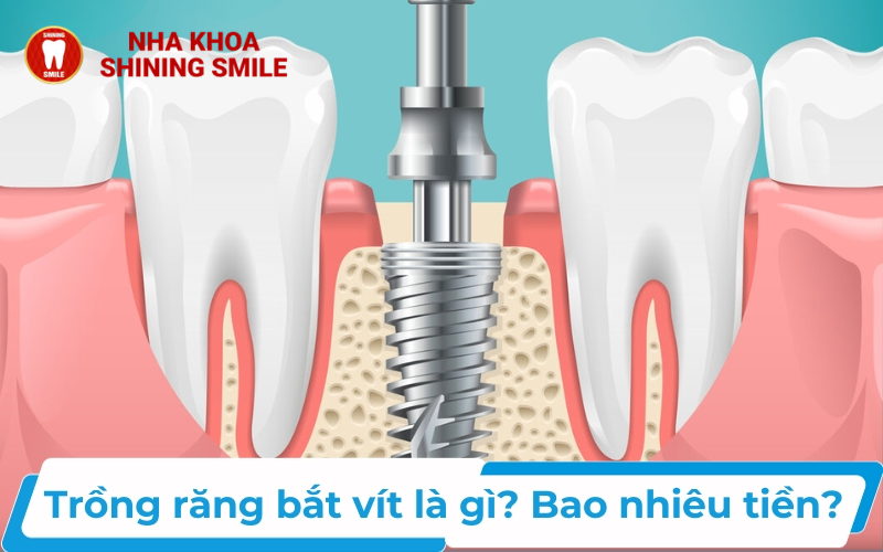 Niềng răng ăn gì? Chế độ ăn uống phù hợp cho người niềng răng