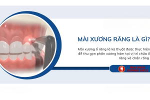Mài Xương Ổ Răng Giá Bao Nhiêu? Cập Nhật Thông Tin Mới!