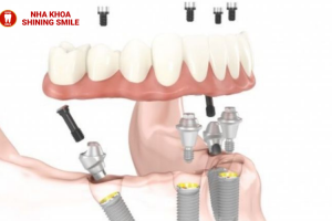 Trồng Răng Implant Bị Sưng: Nguyên Nhân Và Cách Giảm Sưng!