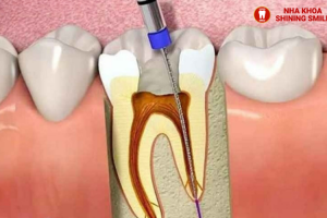 Mắc Cài Tự Buộc 3M: Tính Năng Nổi Bật và Ưu Điểm