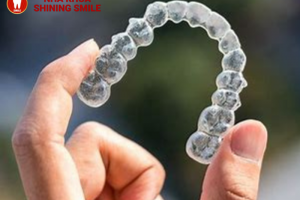 Niềng răng trong suốt giá bao nhiêu? Bảng giá chi tiết 2024
