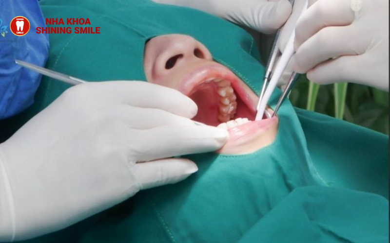 Giá niềng răng mắc cài kim loại mới nhất 2024