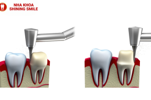 Mài Răng Bọc Sứ: Quy Trình Và Những Điều Cần Biết