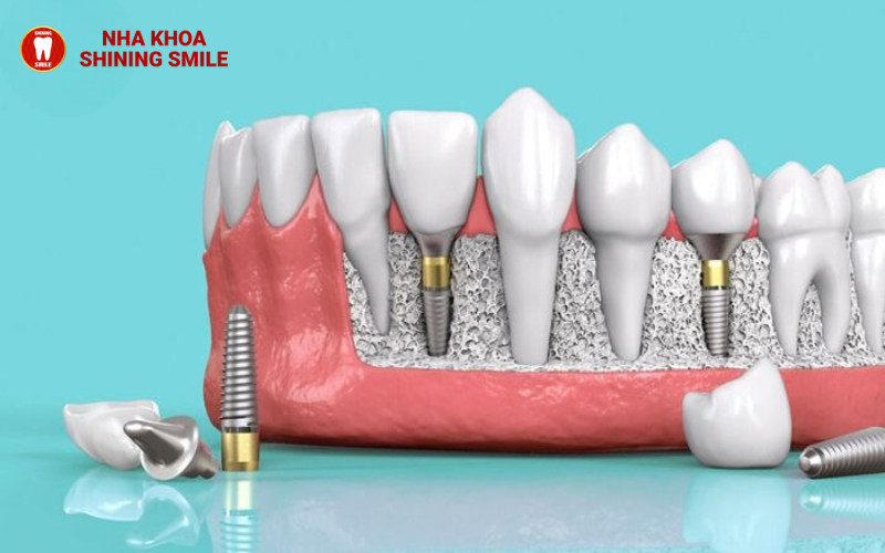 Nguyên nhân gây hóp má khi niềng răng