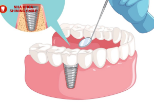 60 Tuổi Có Nên Trồng Răng Không? Lời Khuyên Từ Chuyên Gia!