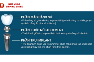 Trồng Răng Implant Giá Bao Nhiêu? Bảng Giá Cập Nhật Mới!