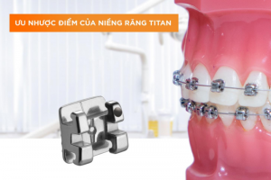 Mắc Cài Răng 6 cánh: Những Điều Cần Biết Về Công Nghệ Niềng Răng 6 cánh