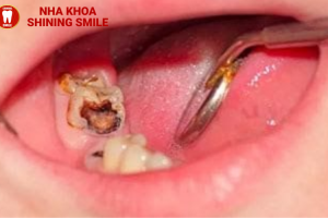 Implant Là Gì? Tất Tần Tật Những Điều Bạn Cần Biết!