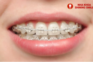 Niềng Răng Có Thể Duy Trì Vĩnh Viễn Được Không?