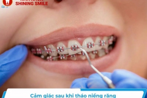 Khám Phá Cảm Giác Sau Khi Tháo Niềng Răng