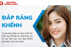 Đắp Răng Khểnh: Xu Hướng Thẩm Mỹ Nha Khoa Hiện Đại
