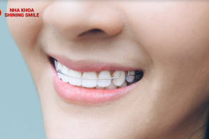 Đeo Hàm Duy Trì: Bạn Có Thể Ăn Uống Bình Thường Không?