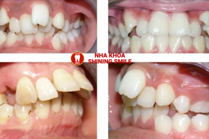 Niềng Răng Lệch Lạc Hiệu Quả Nhất