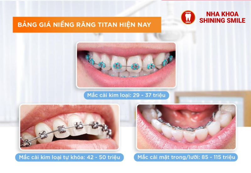 Niềng Răng Vẩu: Giải Pháp Tối Ưu Cho Nụ Cười Hoàn Hảo