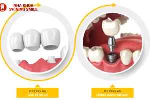 Nụ cười rạng rỡ trở lại - Trồng răng hàm số 7 giá bao nhiêu?
