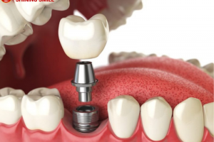 Trồng răng cấm giá bao nhiêu - Bí mật cho nụ cười triệu đô