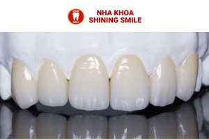 Bọc Sứ Răng Cửa: Giải Pháp Thẩm Mỹ Hoàn Hảo Cho Nụ Cười