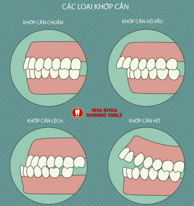 Chỉnh Hình Một Răng Lệch: Phương Pháp và Lợi Ích