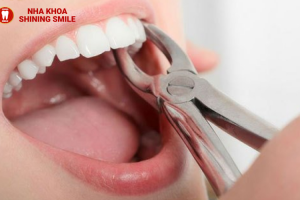 Trồng Implant sau nhổ răng: Bao lâu là thời điểm vàng