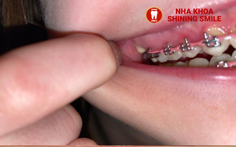 Sử Dụng Bàn Chải Điện Khi Niềng Răng: Lợi Ích và Lưu Ý