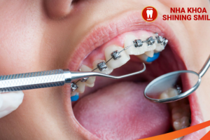 Cơ Chế Hoạt Động Của Niềng Răng: Hiểu Rõ Để Lựa Chọn Đúng