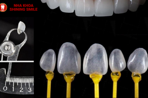 Dán răng sứ không mài - Tự tin khoe nụ cười rạng rỡ, không lo về giá