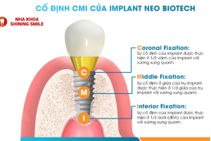 Neobiotech Implant: Công Nghệ Trồng Răng Đỉnh Cao Cho Nụ Cười Hoàn Hảo