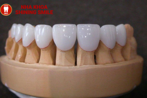 Nên Bọc Răng Sứ Loại Nào? Hướng Dẫn Chi Tiết Từ Chuyên Gia