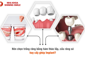 Trồng răng nanh ma cà rồng – Trào lưu hot giới trẻ