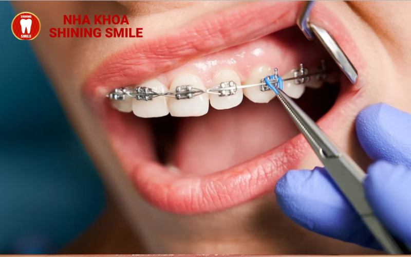 Đánh Giá Hiệu Quả Của Niềng Răng Trainer A1, A2, A3