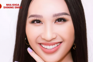 Khám Phá Mắc Cài Sapphire: Lựa Chọn Tinh Tế cho Nụ Cười Hoàn Mỹ