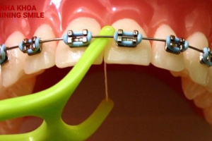 Các lưu ý khi niềng răng: Những điều mà không ai nói cho bạn biết