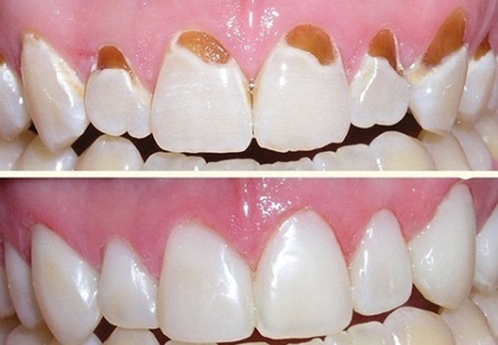 Trám cổ chân răng – Từ A-Z những thông tin bạn cần biết khi thực hiện 2