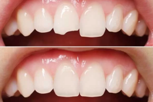 Trám Răng Sứt Bao Nhiêu Tiền? Bảng Giá Cập Nhật