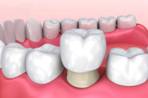 Trước Và Sau Khi Làm Răng Sứ: Những Điều Bạn Cần Biết