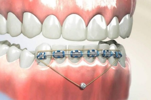 Cấu tạo của khí cụ mắc cài như thế nào?