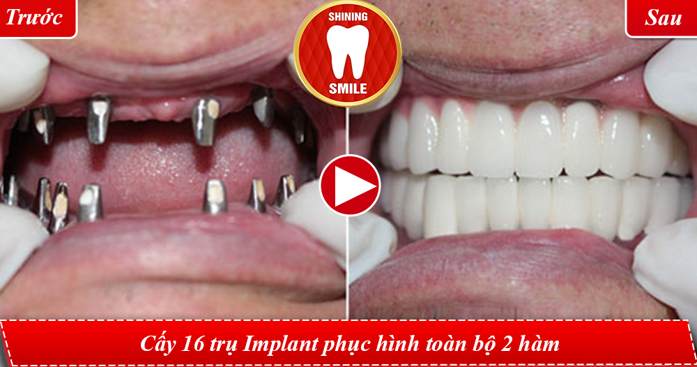 TRỒNG IMPLANT TOÀN HÀM